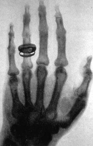 X-ray image in black, white, and gray of a male hand wearing a ring.
